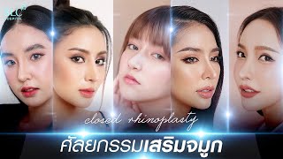 รวมรีวิวเสริมจมูก เทคนิค Closed 5 สาว 5 สไตล์ ที่ SLC Hospital !!