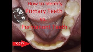 How to Identify Primary Teeth vs. Permanent Teeth
