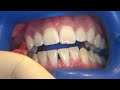 blancone click post hygiene teeth whitening