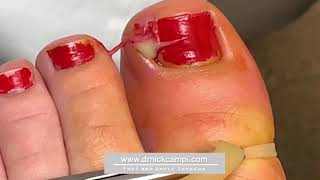 Draining pus from an ingrown toenail