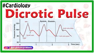 Dicrotic pulse - Internal medicine - #Usmle Cardiology