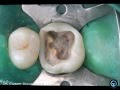 Root Canal Treatment of a Curved Upper Molar with Operating Microscope