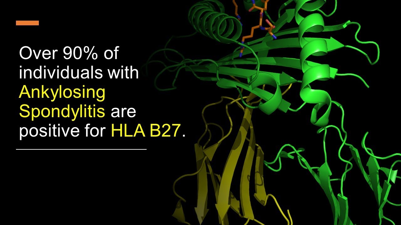 Does HLA B27 Diagnose Ankylosing Spondylitis? - YouTube