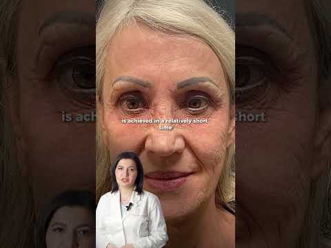 What does a phenol peel do?