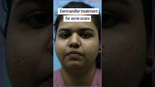 Acne scar treatment | Dermaroller for acne scars | #acnescars #shorts #youtubesh