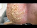 Dry And Cracked Foot Calluses, Scrape Them Clean