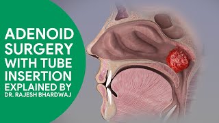 Adenoid Surgery With Tube Insertion By Dr Rajesh Bhardwaj |#Adenoidectomy #Grommets | #eartubes