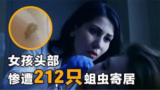 医生以身养蛆，女孩头部惨遭212只蛆虫寄居，画面太恐怖！