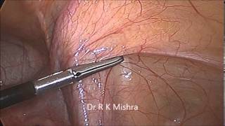 Laparoscopic Demonstration of Pelvic Anatomy