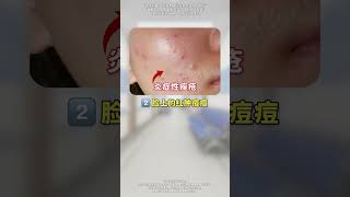 想要痘痘好得快？医生教你分清痘痘类型再处理！#痘痘 #皮肤 #医学科普 #女生必看