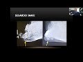 prostep mis refresher webinar hammertoe u0026 dmmo ft. dr. eric baskin