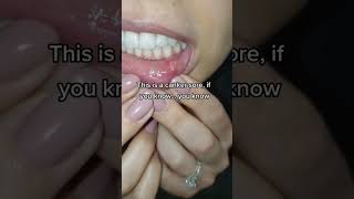 HUGE Canker Sore