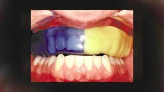 The truth about mouthguard How to prevent the most common cause of dental injury in sports
