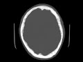 cns c6 skull metastases b