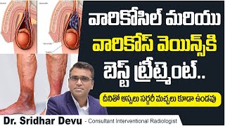 వారికోసిల్, వారికోస్ వెయిన్స్ | Best Treatment for Varicocele | Varicose Veins Treatment | Dr Devu