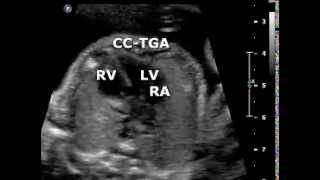 Congenitally corrected transposition of the great arteries