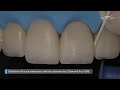 diastema and incisal increase i diastema y alargamiento incisal i diastema e aumento incisal