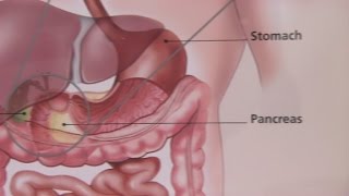 Irritable Bowel Syndrome & Its Symptoms
