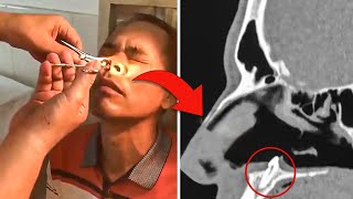 Doctors Find What's Growing Inside his NOSE, After Man Has Intense Itch For Years