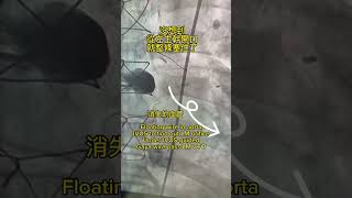 冠狀動脈左主幹慢性全阻塞。Left main coronary CTO。