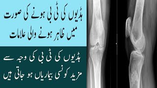 Bones Joint And Spine Tuberculosis Symptoms In Urdu Reedh Ki Haddi Aur Hadion Joron Ki TB Ki 12 Alam