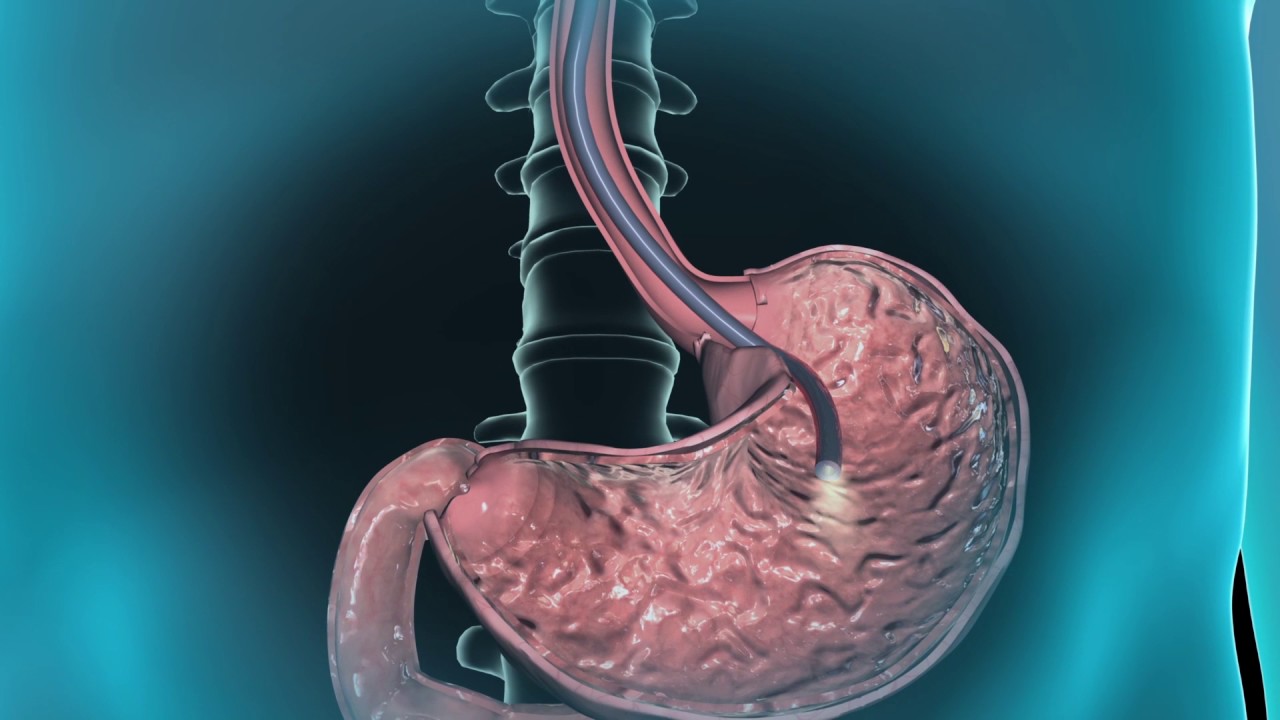 Learn About Gastroscopy Youtube