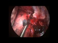 uniportal vats right lower lobectomy and lymphadenectomy step by step