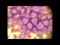 AP2 EXAM 1: BLOOD: LEUKEMIA.avi