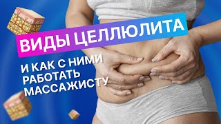 Какие виды целлюлита бывают? И как с ними работать массажисту.