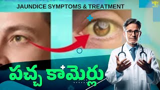 Jaundice Symptoms in Telugu ( పచ్చ కామెర్లు ) Symptoms \u0026 Treatment | Health Tips | Roy Tv Health