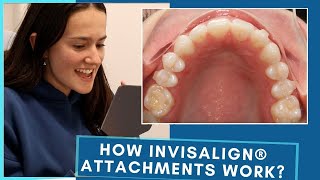 How Invisalign® Attachments Work!