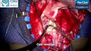 PerClot Temporal Cyst Removal