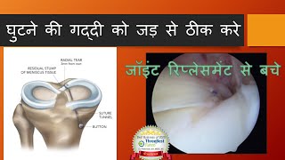 Meniscus Root Tear and its Repair (Hindi). घुटने की गद्दी को जड़ से ठीक करे , घुटने के घिसारे से बचे