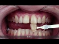 [ENG] Whitening and diastema closure with Whiteness HP AutoMixx and Vittra APS.