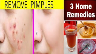 মাত্র ৭দিনে ব্রণ(Pimples Removal)থেকে মুক্তির ৩টি ঘরোয়া উপায়/Acne Removal at home/Brono theke mukti