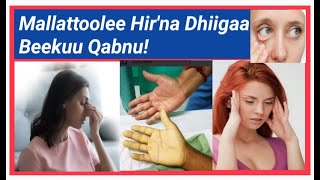 Dhukkuba Hir'ina dhiigaa(anemia)