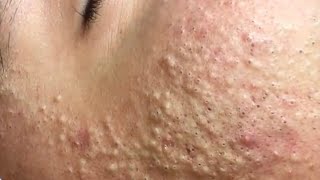 Huyen phan treantment acne #111 #acne #mun #nanmun #treatment #trending