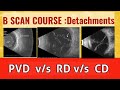 B scan course || differentiate retinal detachment from vitreous detachment and choroidal detachment