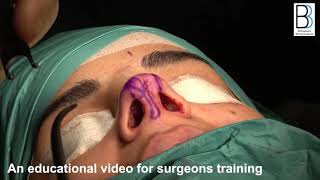 Magic Rhinoplasty [22 minutes] - Case 2