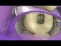 root canal flare up endodontic drainage