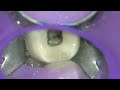 root canal flare up endodontic drainage