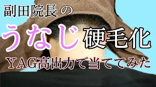 【硬毛化】医療脱毛の副作用硬毛化をヤグレーザー高出力で退治してみました【医療脱毛】