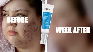 TESTING MURAD OUTSMART BLEMISH/ACNE TREATMENT FOR A WEEK: OILY/ACNE PRONE SKIN