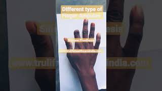 Type of Finger Amputation  | Best Treatment of Finger Lost or Birth Defect  of Finger செயற்கை விரல்