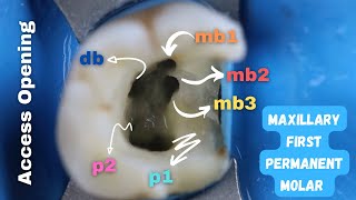 How To Find Mesiobuccal Canals (mb1,mb2,mb3) Easily 🟡 Access Opening  iin maxillary first molar