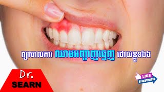 How to Treat Bleeding Gums at Home ព្យាបាលការឈាមអញ្ចាញធ្មេញដោយខ្លួនឯង