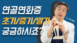 무릎앞쪽통증원인, 연골연화증 왜 조기치료가 중요한가? 단계별 증상차이를 확인하세요!