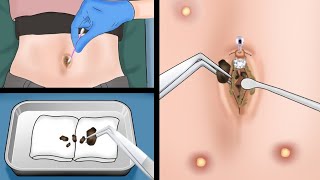 Is Your Belly Button Clean? ASMR Dirt and stone removal in deep belly button of fat girl | #asmr