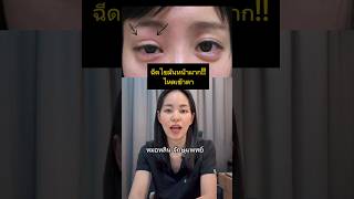 ฉีดไขมันหน้าผากไหลเข้าตา #หมอหลิน #จักษุแพทย์ #หมอตา#โรคตา#สารพัดเรื่องตา#ฟิลเลอร์ใต้ตา#ทําตาสองชั้น