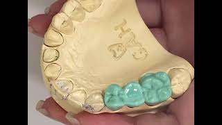 maxillary second premolar pontic wax up